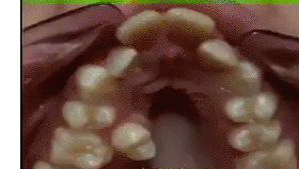치아 교정의 위력