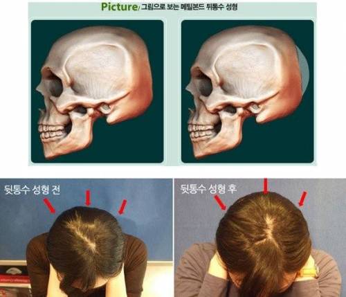 뒷통수 성형