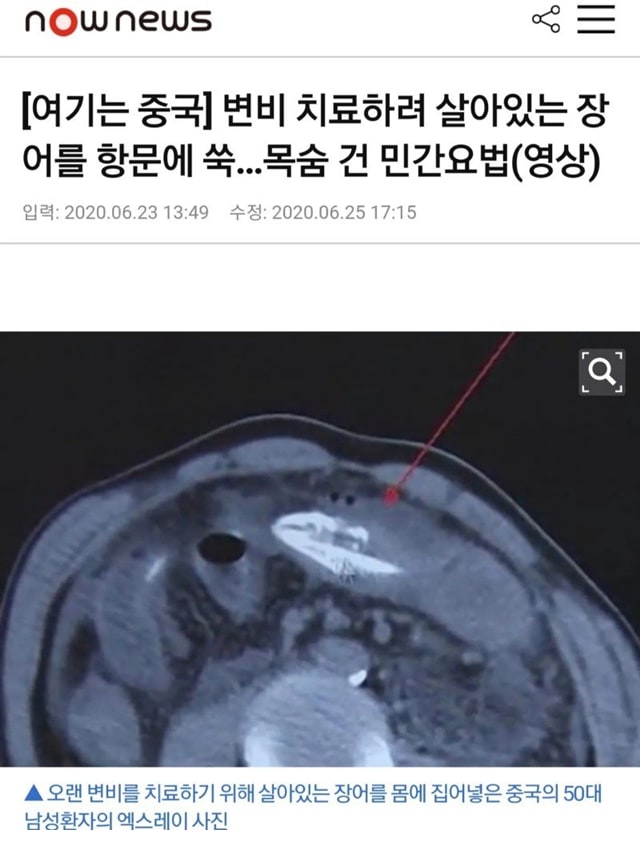 변비 고치는 황당한 민간요법