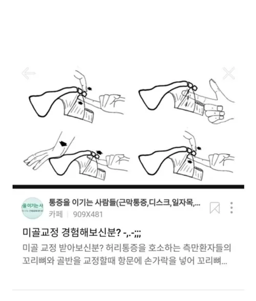 미골교정 아시나요?ㄷㄷㄷ