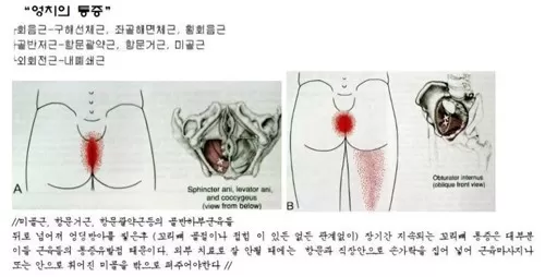 미골교정 아시나요?ㄷㄷㄷ